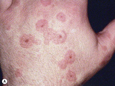 stevens johnson syndrome mild rash