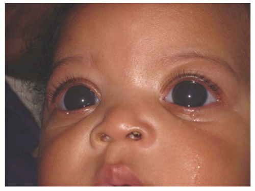 signs of glaucoma in babies