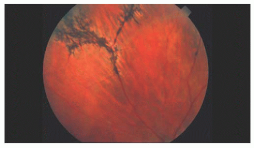 retina lattice degeneration