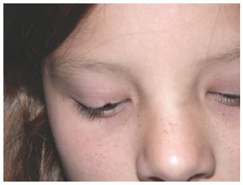 Serial photographs of lower eyelid inferior displacement during eye