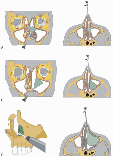 Medial Maxillectomy Endoscopic Ento Key 9393