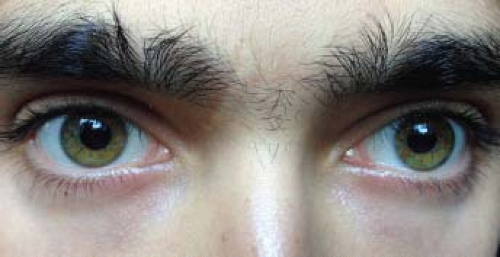 constricted pupils migraine