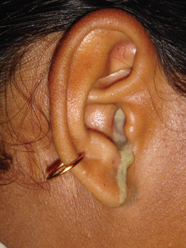 impacted ear wax symptoms