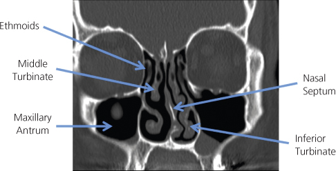 Paranasal sinus shop disease