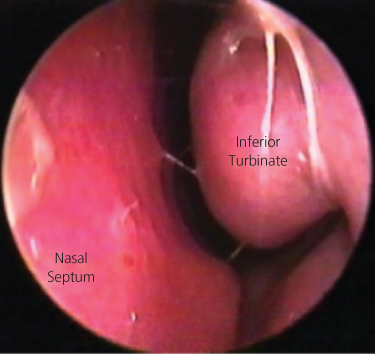 Paranasal deals sinus disease