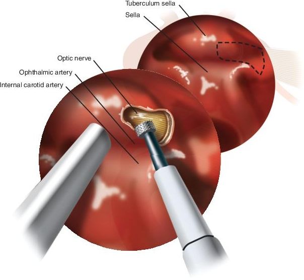 Optic Nerve Decompression Ento Key