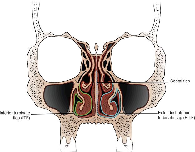 Inferior Turbinate Flap Ento Key 4364