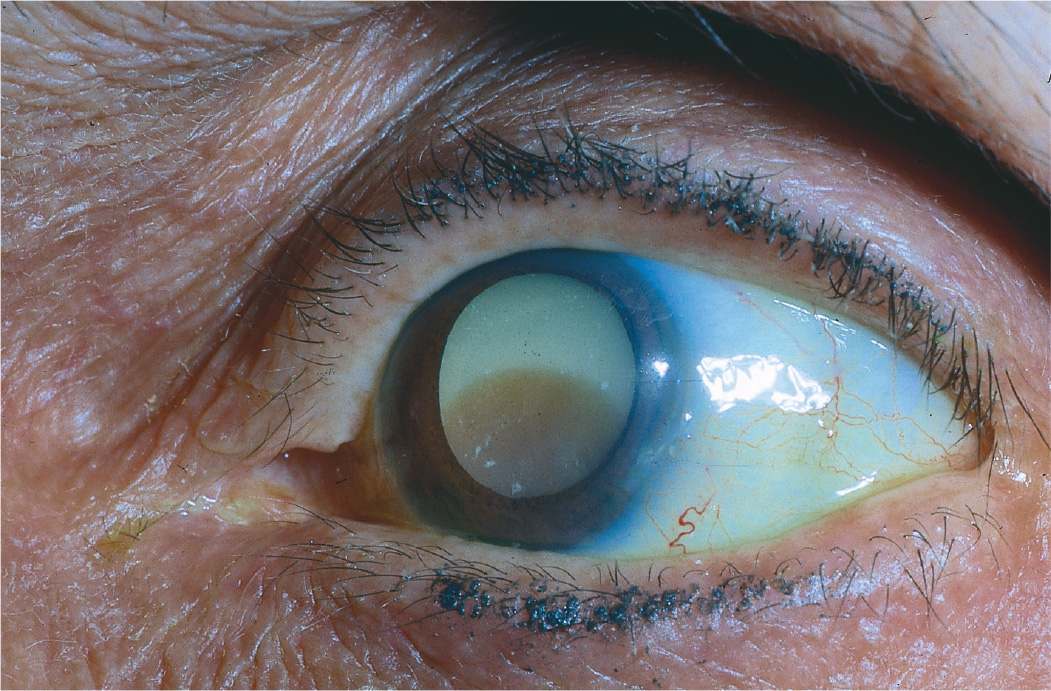 11 Lens Cataract Ento Key