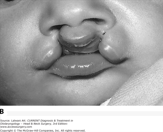 bilateral cleft lip ultrasound