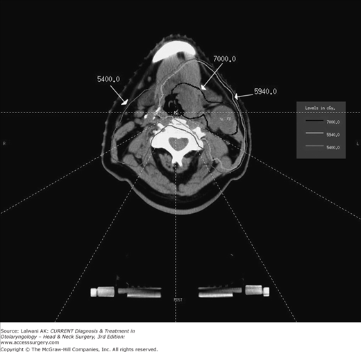 Benign & Malignant Lesions Of The Oral Cavity, Oropharynx & Nasopharynx ...