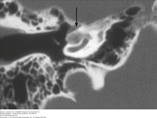 Otosclerosis, Otolaryngology⁠ — Head & Neck Surgery