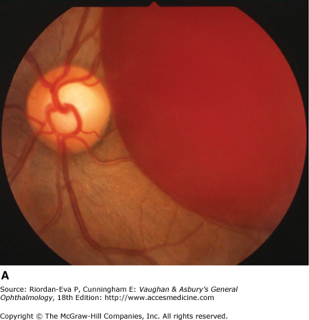 Ocular Disorders Associated with Systemic Diseases | Ento Key