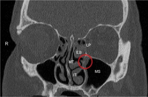 Concha bullosa средних носовых раковин что это. Булла средней носовой раковины. Конхобулла средней носовой раковины слева. Конхобуллез носовой раковины справа. Кт носа coronal.