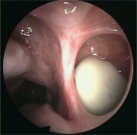 ostium maxillary sinus