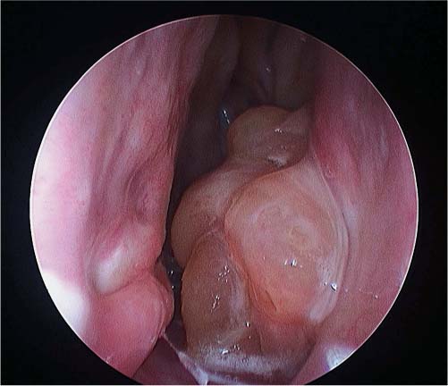 inverted papilloma endoscopic removal