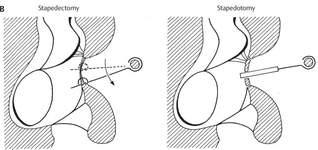 Stapedectomy of the Stapes of the Ear - Labelled – Medical Stock