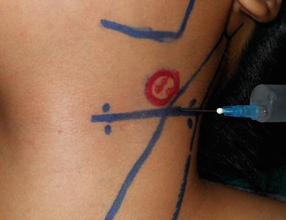 Graphene tattoo provides cuffless blood-pressure monitoring - Biomat | The  Biomaterials Network