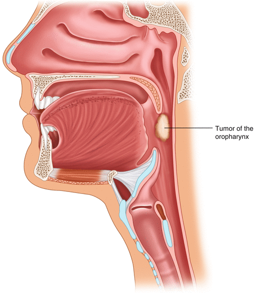 bumps on pharynx