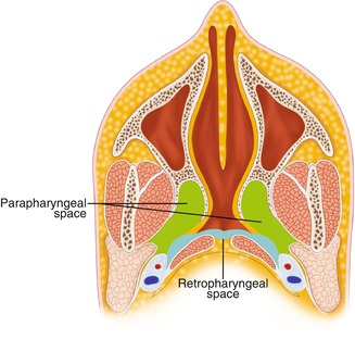 retropharyngeal abscess diagram