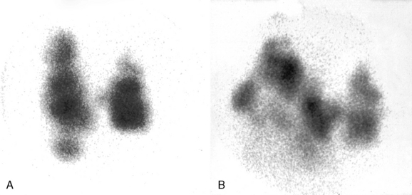 hyperthyroidism-toxic-nodular-goiter-and-graves-disease-ento-key