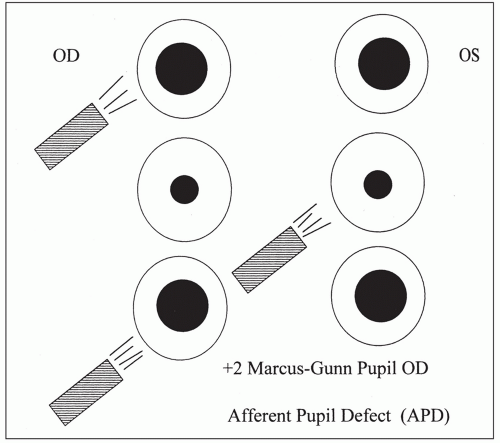 dx code for miotic pupil