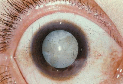 Cataract Clinical Types Ento Key