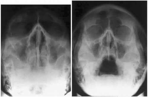 superior orbital fissure radiology