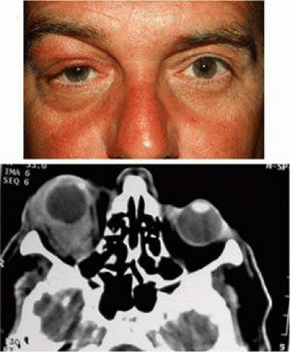Lymphoproliferative Myeloproliferative And Histiocytic Lesions Of The 
