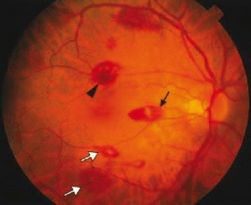 retinal flame hemorrhage