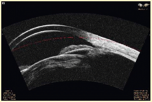 Evaluation of the Posterior Chamber, Vitreous, and Retina with ...