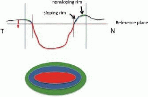 Where Is the RNFL Measured? - EyeCarePD