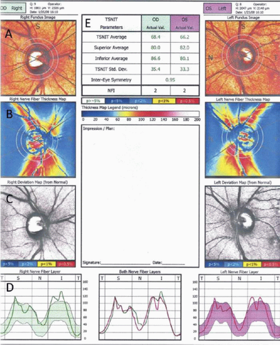 Where Is the RNFL Measured? - EyeCarePD