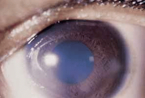 Varicella and Herpes Zoster Ocular Disease | Ento Key