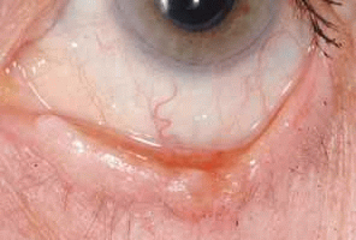 Tumors Of The Eyelids Ento Key