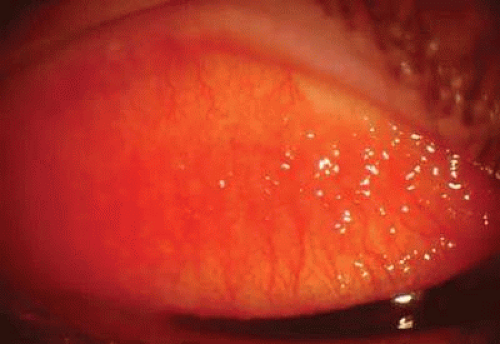 giant papillary conjunctivitis symptoms