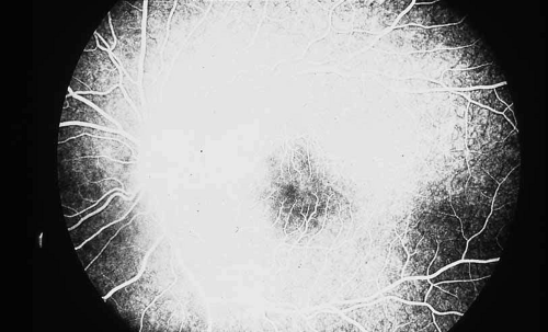 An example of sodium-fluoresceine with a clear delineation of the