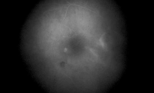 Fluorescein and Indocyanine Green Angiography | Ento Key