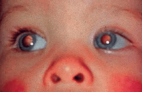 Retinoblastoma And Simulating Lesions Ento Key