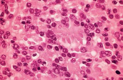 Retinoblastoma And Simulating Lesions Ento Key