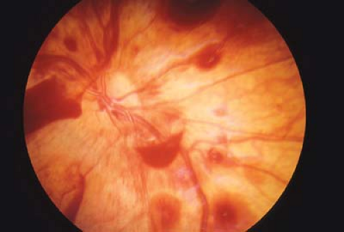 retinal hemorrhage shaken baby