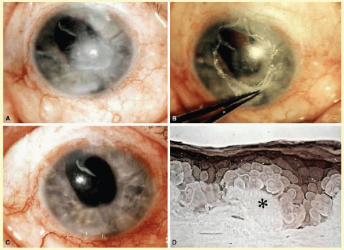 Superficial Keratectomy | Ento Key