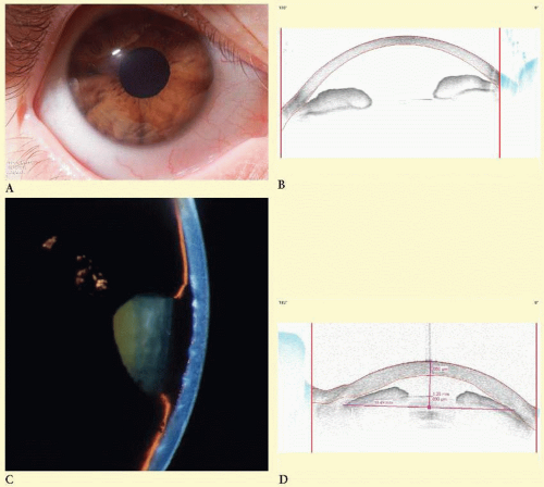 Secondary Angle-Closure Glaucoma | Ento Key