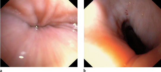 lower esophageal sphincter endoscopy