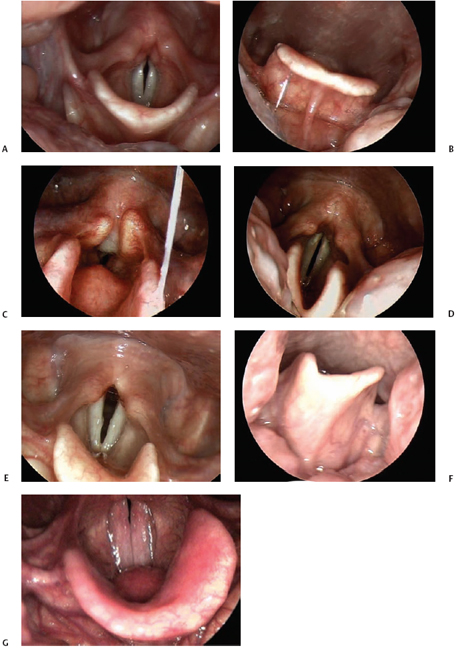 Normal Laryngeal Variability Ento Key