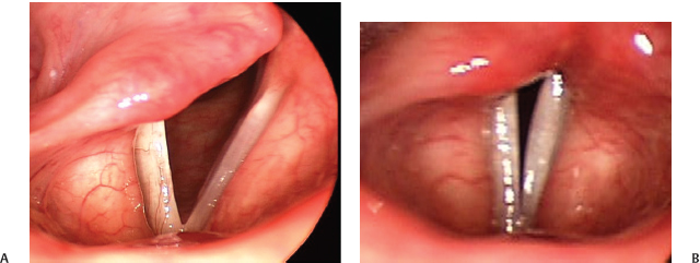 Introduction to Videostroboscopy | Ento Key