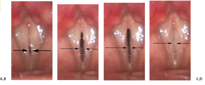 Normal Vocal Fold Symmetry and Phase Characteristics Ento Key