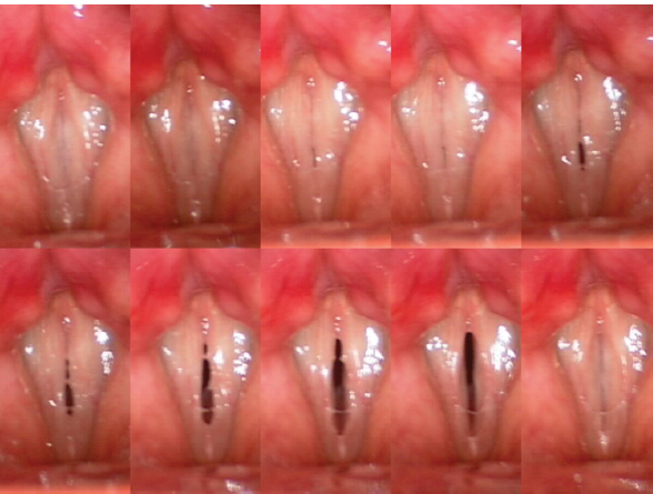 Normal Vocal Fold Symmetry and Phase Characteristics Ento Key