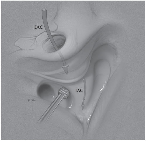 vascular loop internal auditory canal treatment