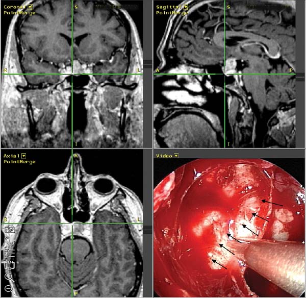 Endoscopic Resection Of Pituitary Tumors Ento Key 8933