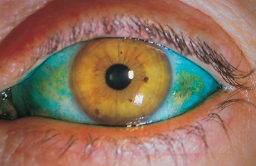 Systemic Diseases And Conjunctivitis Ento Key